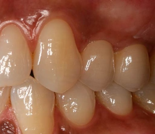 Caso clínico: rehabilitación con implantes y coronas de porcelana — después
